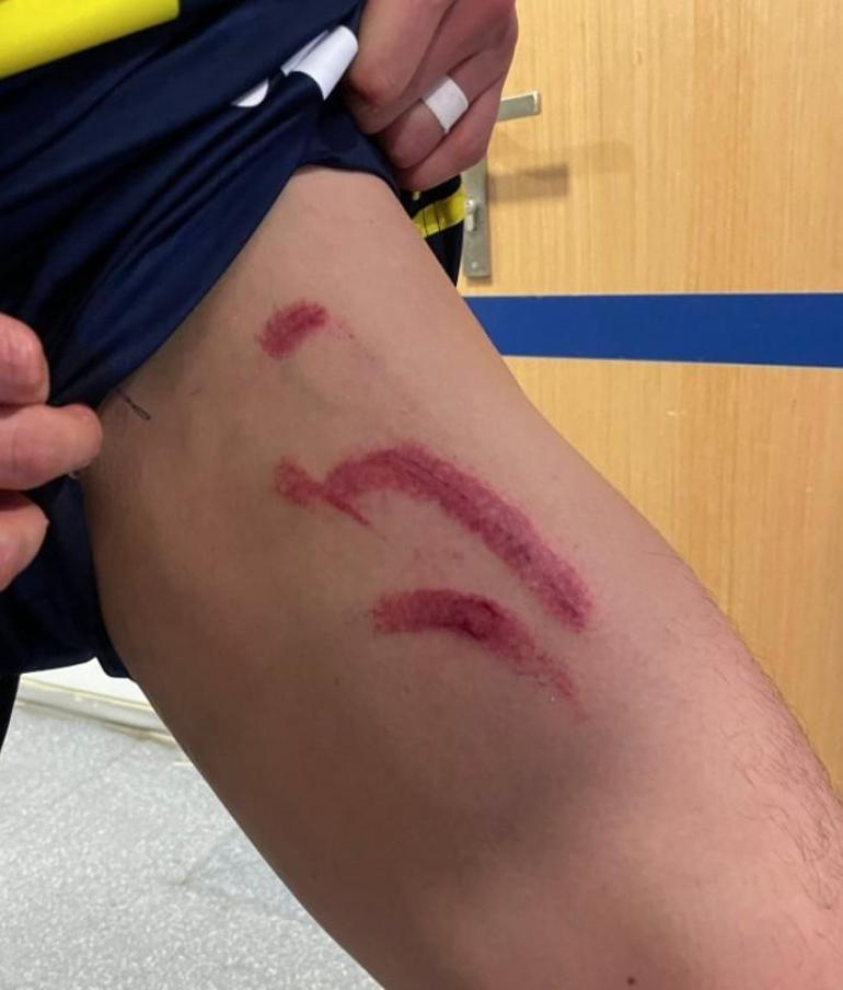 Edson Alvarezin sakatlığında son durum Stuttgart maçının ardından bacağının durumunu paylaşmıştı